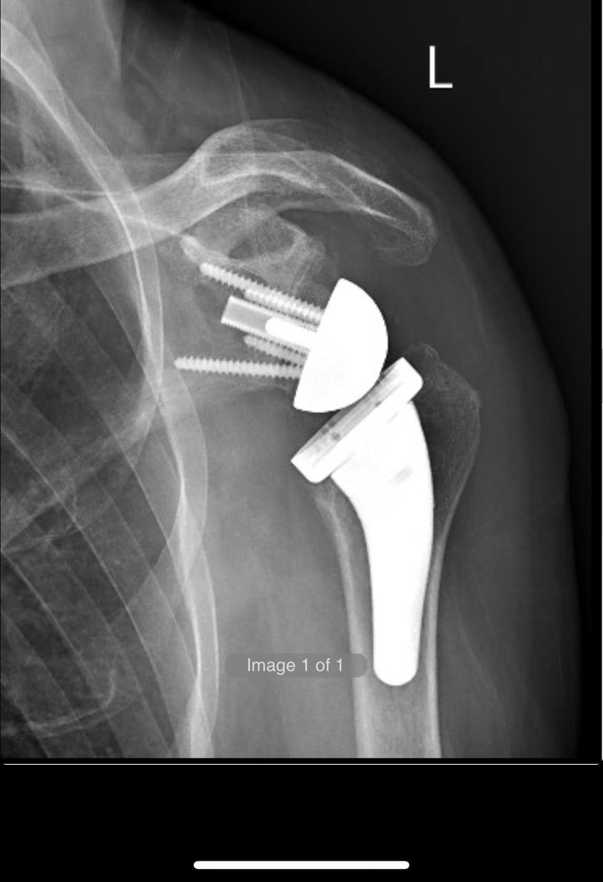 Shoulder X-Ray