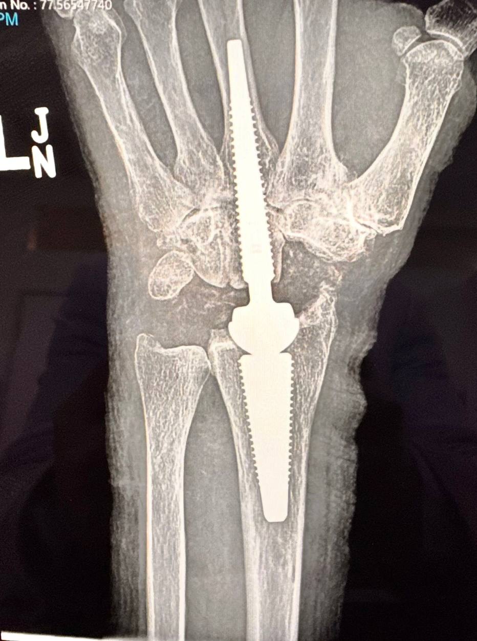 Wrist X-Ray